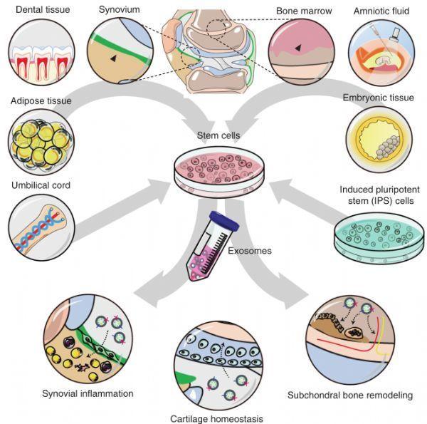 干細(xì)胞來源的外泌體對(duì)骨性關(guān)節(jié)炎的治療