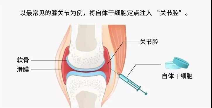 △ 間充質(zhì)干細(xì)胞定點(diǎn)注入“關(guān)節(jié)腔”