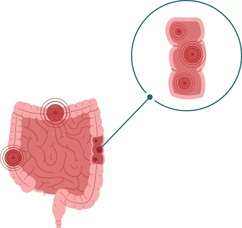 炎性腸病孤立白色