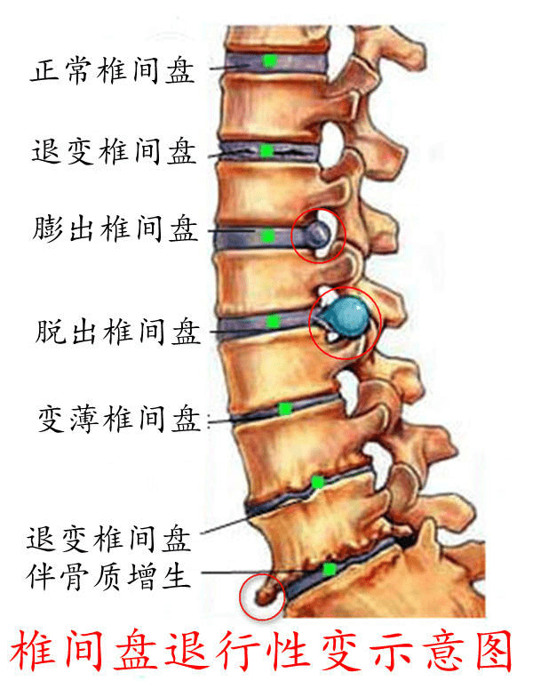 椎間盤退行性變示意圖