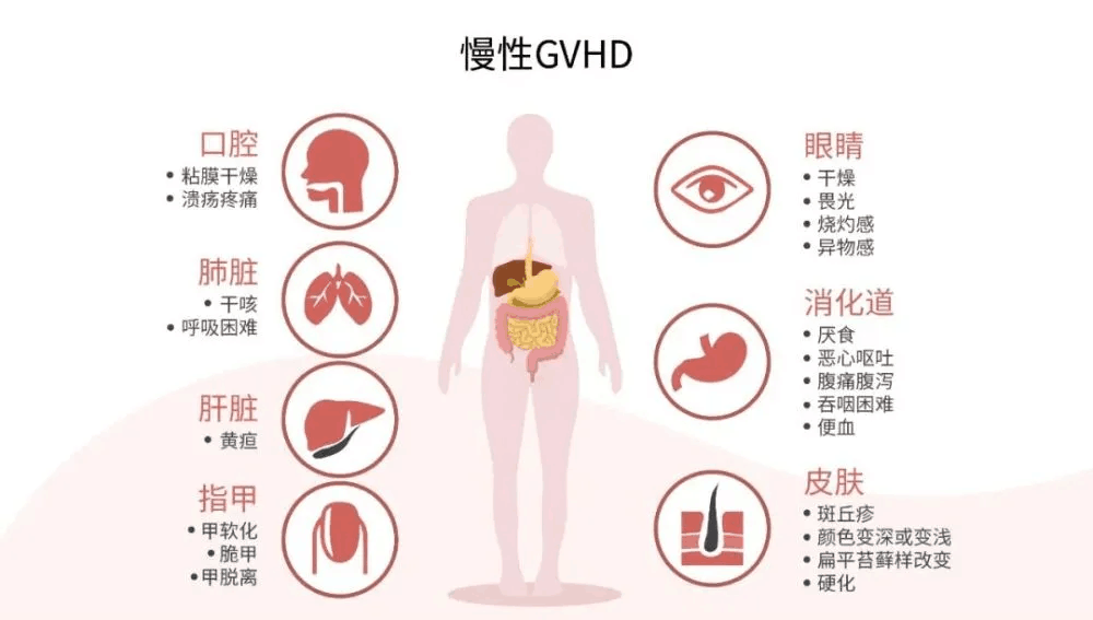 慢性移植物抗宿主病