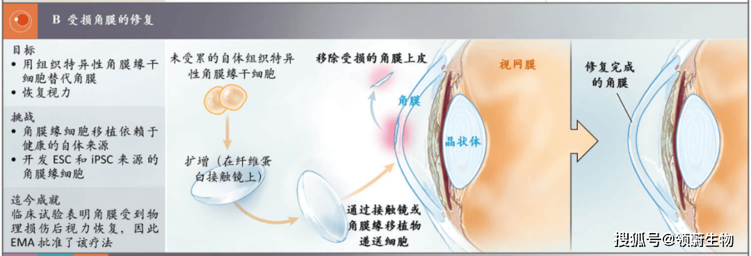 受損角膜的修復(fù)