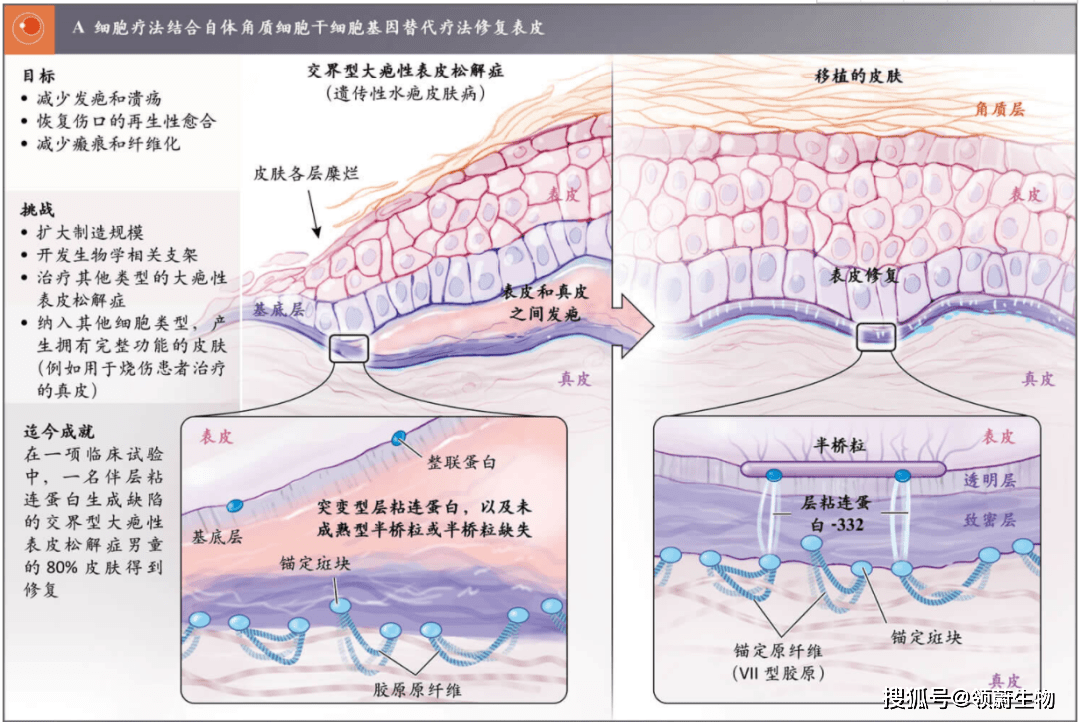 干細(xì)胞治療修復(fù)表皮