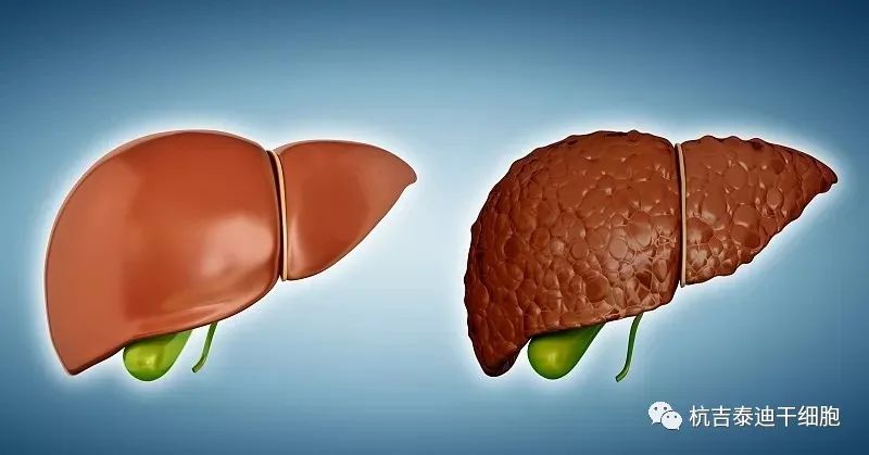 正常肝脏与肝硬化肝脏对比