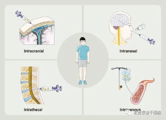 干细胞治疗脑瘫患者的常用给药途径