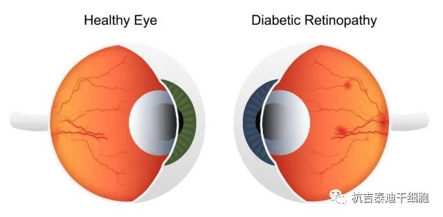 正常眼球与糖尿病视网膜病变眼球对比图