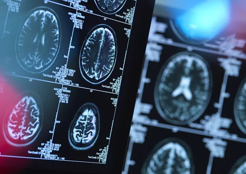 对患有神经系统疾病患者的脑部进行扫描