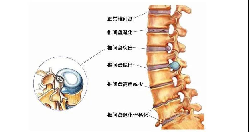 腰間盤突出疼痛難忍?