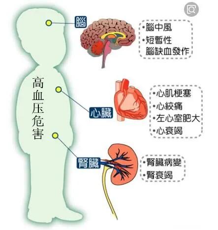 控制高血壓預防併發症幹細胞療法應對高血壓併發症前景可期